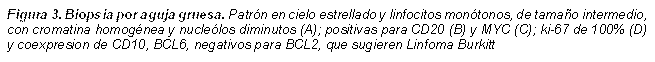 Figura 3. Biopsia por aguja gruesa. Patrón en cielo estrellado y linfocitos monótonos, de tamaño intermedio, con cromatina homogénea y nucleólos diminutos (A); positivas para CD20 (B) y MYC (C); ki-67 de 100% (D) y coexpresion de CD10, BCL6, negativos para BCL2, que sugieren Linfoma Burkitt - Descripción: Figura 3.  Biopsia por aguja gruesa. Patrón en cielo estrellado y linfocitos monótonos, de tamaño intermedio, con cromatina homogénea y nucleólos diminutos (A); positivas para CD20 (B) y MYC (C); ki-67 de 100% (D) y coexpresion de CD10, BCL6, negativos para BCL2